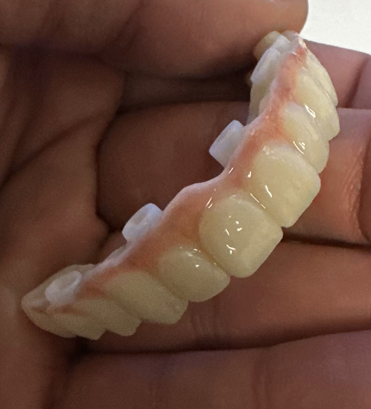 Implant Supported Dentures Houston, TX Smile 32 Dentistry